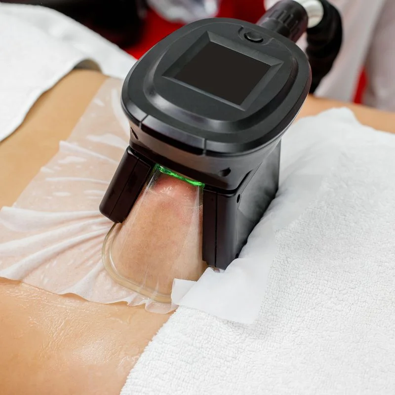Fat Freezing treatment Springs Mire
